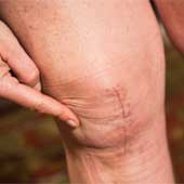 How much compensation for a knee injury claim or settlement